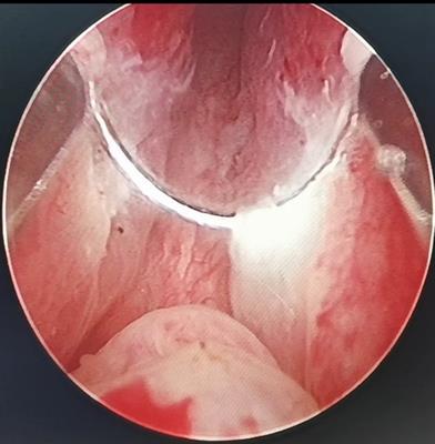 Clinical Study on the Application of Preserved Urethral Mucosa at the Prostatic Apex in Transurethral Plasmakinetic Resection of the Prostate